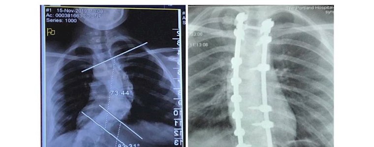 Hatties story - spinal sciolosis surgery