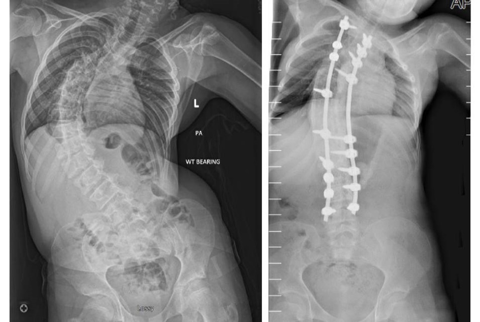 Julies scoliosis story spinal image